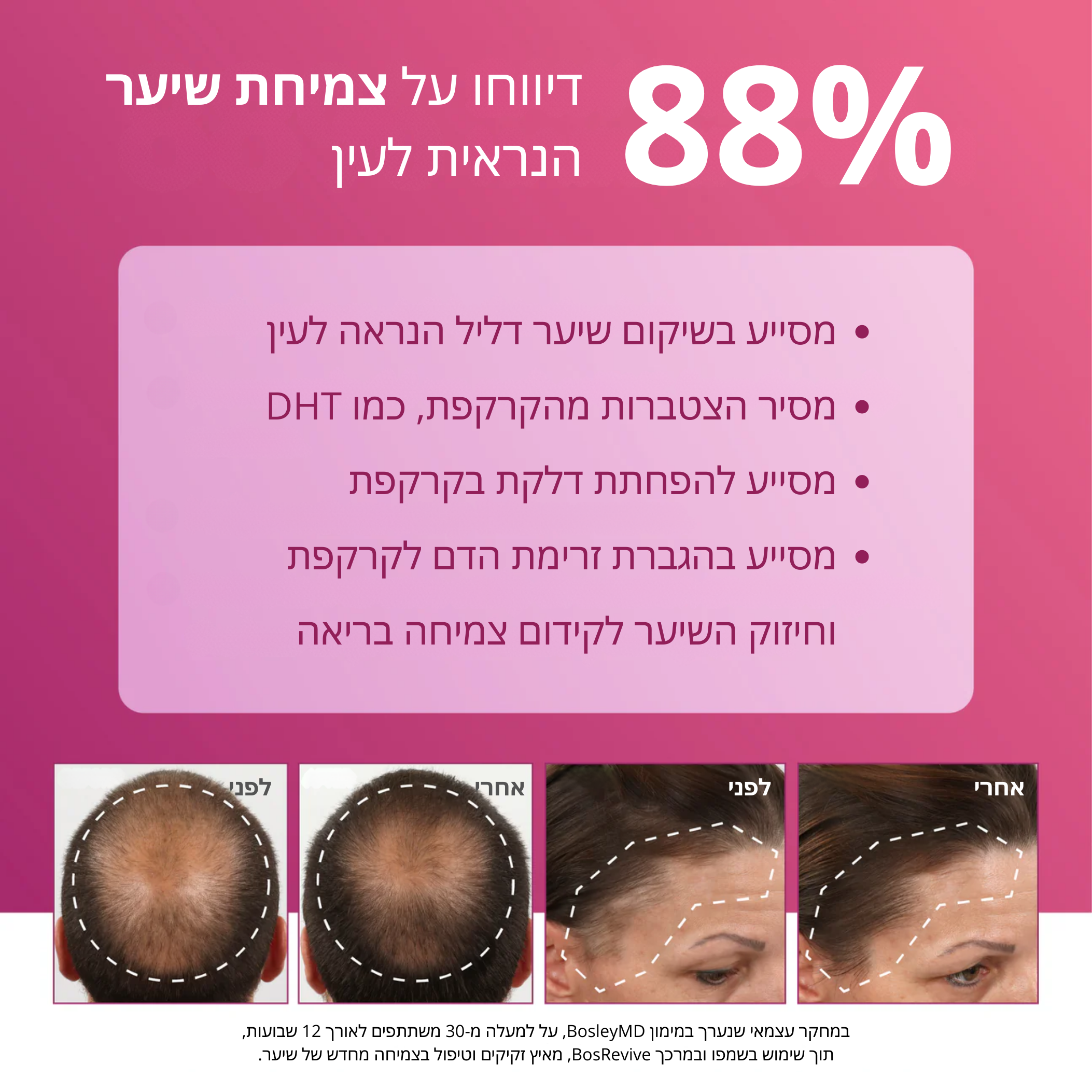 Minoxidil 5% Extra Strength Foam for Women | קצף מינוקסידיל 5% לאישה – חוזק מירבי (2 חודשים)