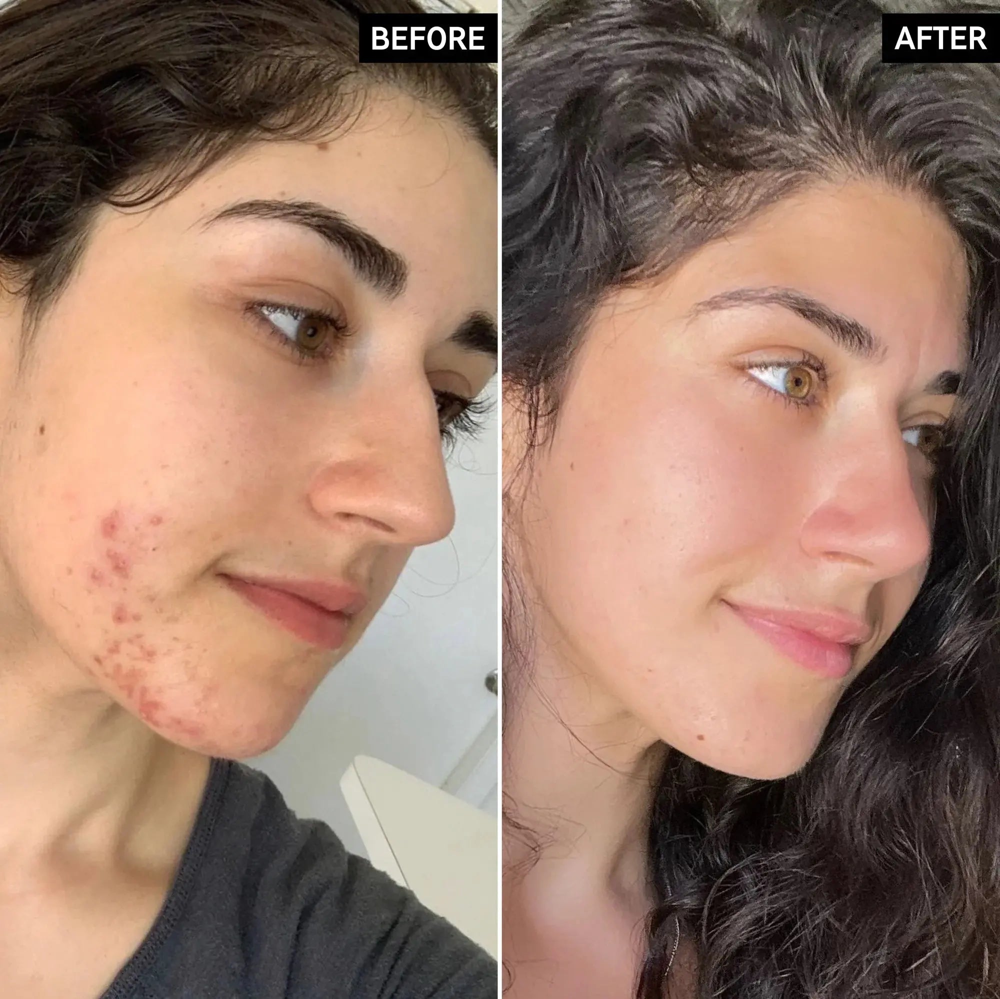 The Intro Routine for Clearer Skin | מארז אנטי אקנה לשגרת טיפוח לעור בהיר יותר.